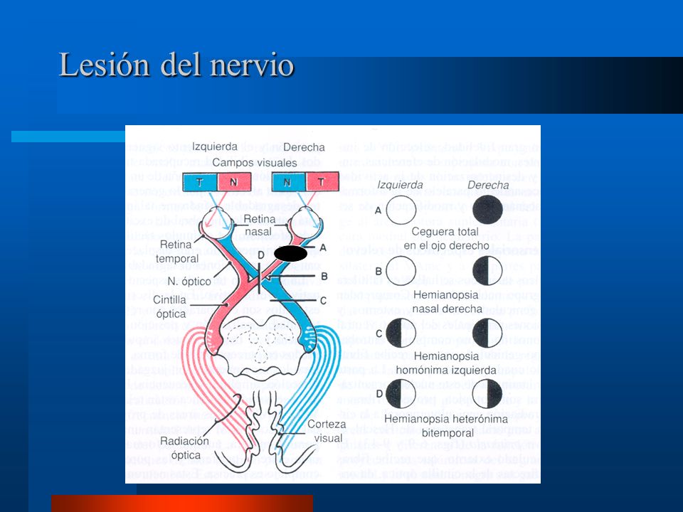 HEMIANOPSIA NASAL PDF DOWNLOAD HEMIANOPSIA NASAL PDF DOWNLOAD